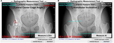 Acetabular Edge Loading During Gait Is Elevated by the Anatomical Deformities of Hip Dysplasia